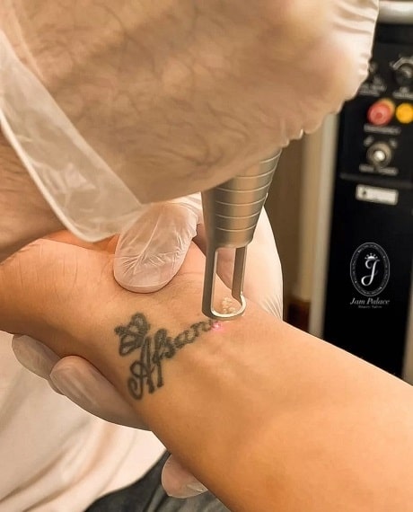 ریموو تتو قدیمی 3 پاك كردن تاتو در يك جلسه