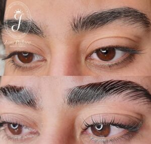 لیفت ابرو چیست؟